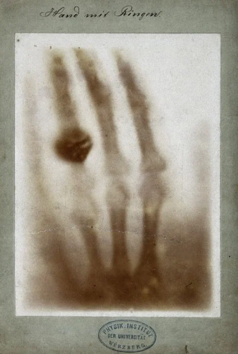 Röntgen’s first “medical” X-ray photo was of his wife’s hand, but, one month later. This photo comes from the University of Würzburg.